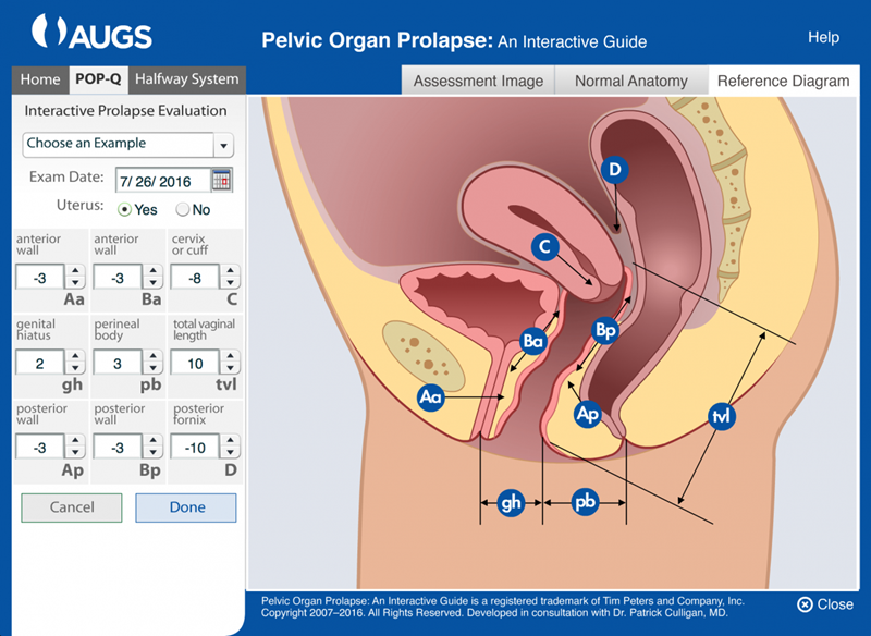 POP-Q Tool - Healthcare Providers