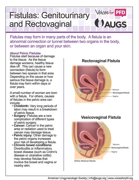 Fistulas_LARGE_PRINT_Page_1